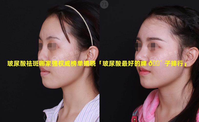 玻尿酸祛斑哪家强权威榜单揭晓「玻尿酸最好的牌 🌴 子排行」